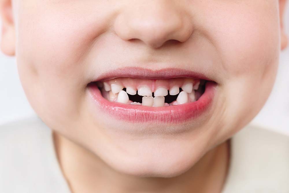 A smiling child with missing teeth illustrates the concept of missing tenants in vacant retail spaces.